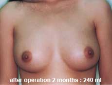 plastic-surgery-breast-augmentation 